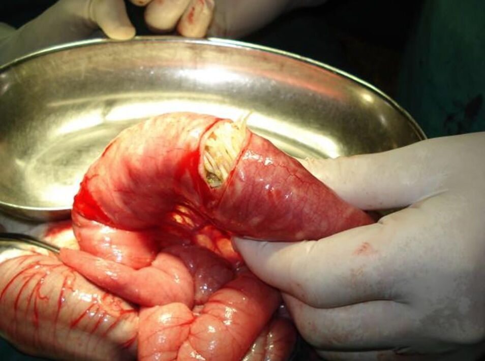 Viermi rotunzi în intestinul uman